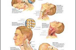 Whiplash injuries chart, head and neck
