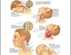 Whiplash injuries chart, head and neck