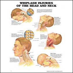 Whiplash injuries chart, head and neck