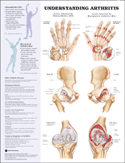 Chart illustrates joints affected by arthritis