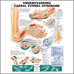 Understanding Carpal Tunnel Syndrome Wall Chart- Laminated, 20"W x 26"