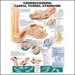 Chart illustrates carpal tunnel syndrome