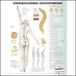 Chart illustrates osteoporosis