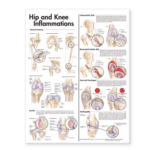 Hip and Knee Inflammations Chart